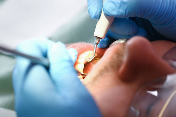 Best Urgent Care for Lost Fillings or Crowns in Bayou Country Clu, LA